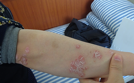 山東治療銀屑病的醫院