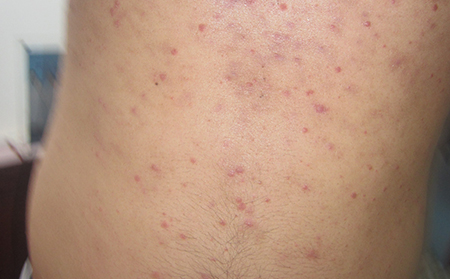 點滴銀屑病癬初次病發