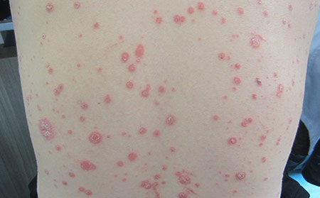 點滴銀屑病癬完全病發