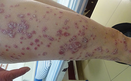 秋季副銀屑病護理,秋季副銀屑病怎樣護理,銀屑病治療醫院