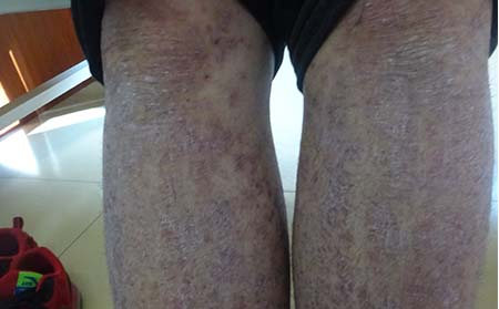 牛皮癬擴散的原因,為什么牛皮癬會擴散,濰坊牛皮癬專科醫院