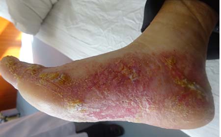 腳部牛皮癬癥狀,腳上長牛皮癬癥狀表現,濰坊牛皮癬專科醫院