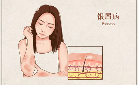 中西醫談什么是銀屑病牛皮癬