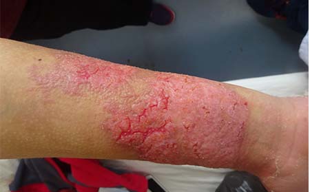 秋季銀屑病預防,怎樣能緩解銀屑病,銀屑病醫院