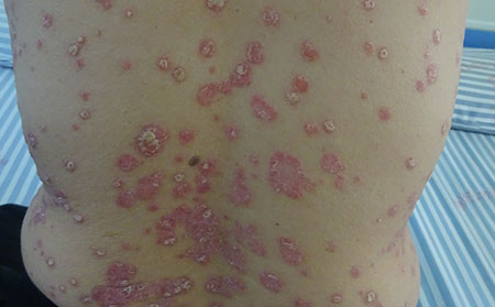 秋季牛皮癬病因,秋季牛皮癬加重原因,牛皮癬治療醫院