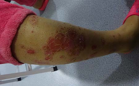 銀屑病瘙癢治療,怎樣治銀屑病瘙癢,濰坊銀屑病醫院