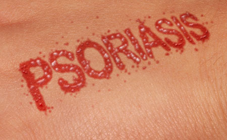 尋常型牛皮膚癬的具體癥狀有哪些