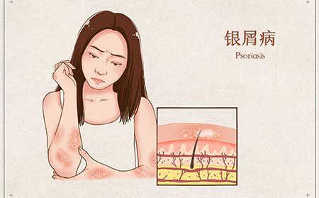 牛皮膚癬尋常型的圖片癥狀