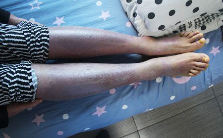 銀屑病病因,過敏誘發銀屑病,濰坊東方銀屑病研究院