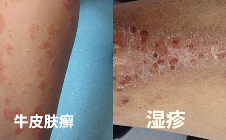 牛皮膚癬和濕疹的區別