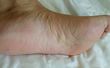 常州牛皮癬哪家醫院治療的效果好