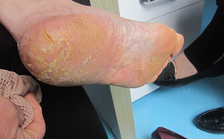 江蘇吃什么藥可以治好牛皮癬