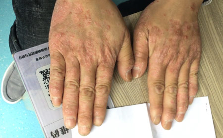 南通牛皮癬用什么藥治好