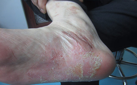 蘇州牛皮癬不能吃什么