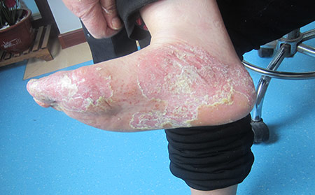 宿遷醫(yī)院治療牛皮癬怎么治療