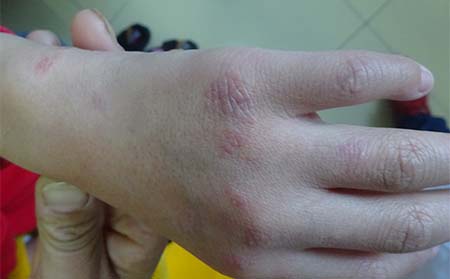 手部銀屑病癥狀,手上銀屑病癥狀表現,濰坊東方銀屑病研究院