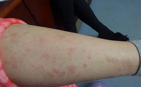 女性牛皮癬治療,怎樣治女性牛皮癬,濰坊牛皮癬?？漆t院