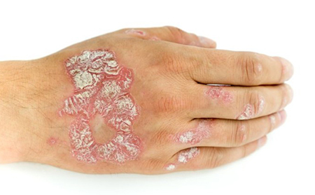 早期牛皮膚癬的癥狀是什么