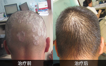 頭皮牛皮膚癬癥狀圖片對比,牛皮膚癬對比圖片