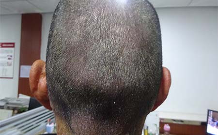 頭部牛皮癬怎么辦,頭部有牛皮癬怎么辦,濰坊牛皮癬專科醫(yī)院