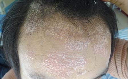 男性銀屑病治療,怎樣治男性銀屑病,濰坊銀屑病醫院