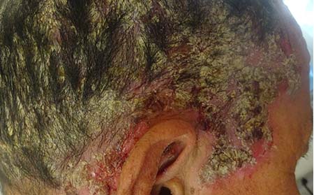 頭部牛皮癬癥狀,頭部患上牛皮癬表現,濰坊牛皮癬專科醫院