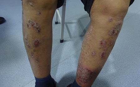 牛皮病癬,牛皮病癬癥狀表現(xiàn),牛皮癬治療醫(yī)院