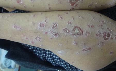 銀皮癬,銀皮癬癥狀,銀皮癬癥狀表現(xiàn),濰坊銀屑病醫(yī)院