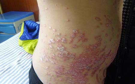 牛皮蘚,牛皮蘚癥狀,牛皮癬治療醫(yī)院