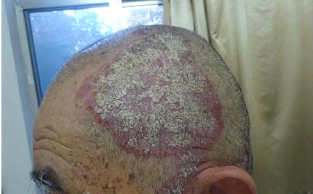 頭皮屑癬,頭皮屑癬癥狀,濰坊東方銀屑病研究院
