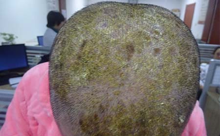 頭部牛皮癬癥狀,頭部牛皮癬什么樣,濰坊牛皮癬專科醫(yī)院