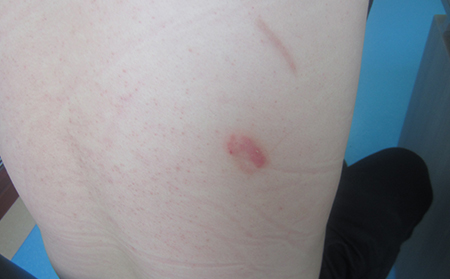 點(diǎn)滴狀牛皮膚癬的癥狀圖片