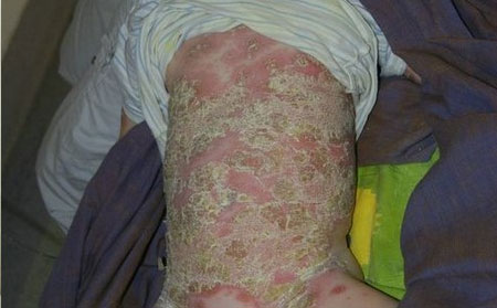 牛皮鮮,怎樣治好牛皮鮮,濰坊牛皮癬專科醫院
