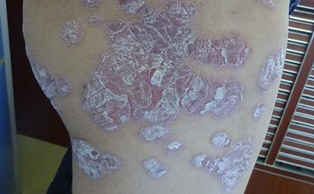 牛皮癬護理方法,有牛皮癬怎樣護理,牛皮癬治療醫院