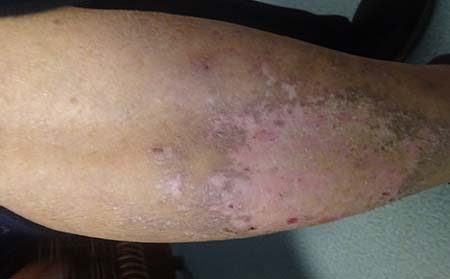 尋常型銀屑病,尋常型銀屑病注意事項,濰坊銀屑病治療醫院