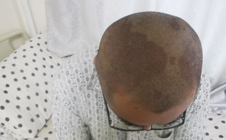 牛皮鮮,頭部牛皮鮮,牛皮鮮癥狀,牛皮癬治療醫院