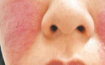 怎樣用藥治銀屑病,兒童銀屑病治療用藥,濰坊銀屑病醫院