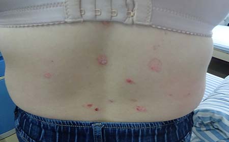 銀皮屑,銀皮屑癥狀,濰坊東方銀屑病研究院