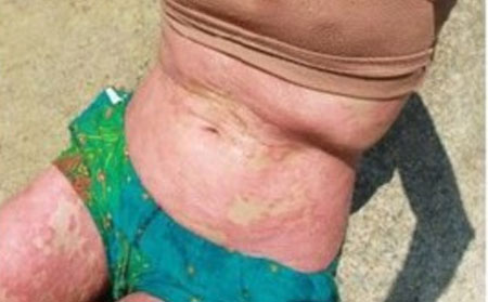 牛皮鮮,牛皮鮮遺傳嗎,濰坊牛皮癬專科醫(yī)院