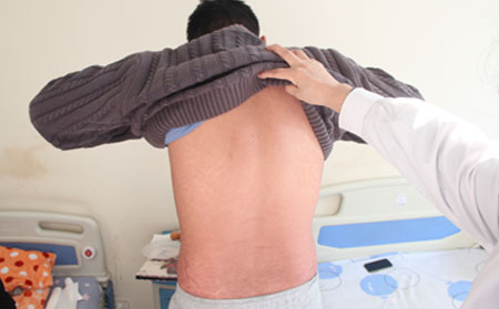 銀屑病治療,男性銀屑病治療,銀屑病醫院