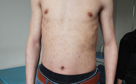 銀屑病癥狀,胸部銀屑病狀,濰坊銀屑病醫(yī)院
