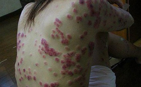 銀屑病治療,兒童銀屑病怎樣治,濰坊銀屑病治療醫院