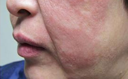 牛皮癬癥狀,面部牛皮癬癥狀,治療牛皮癬醫(yī)院,牛皮癬專科醫(yī)院  
