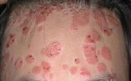 銀屑病怎么辦,額頭有銀屑病怎么辦,治療牛皮癬醫(yī)院,牛皮癬專科醫(yī)院