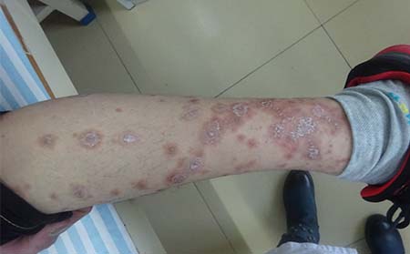 牛皮癬治療,牛皮癬發病后治療,治療牛皮癬醫院,牛皮癬專科醫院 