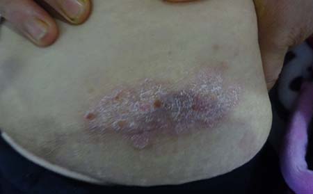 牛皮癬癥狀,男性牛皮癬癥狀,治療牛皮癬醫院,牛皮癬專科醫院