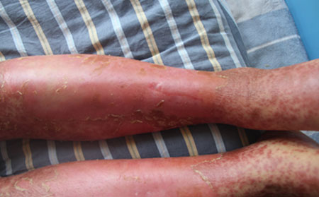 銀屑病癥狀,紅皮型銀屑病癥狀,治療牛皮癬醫院,牛皮癬專科醫院