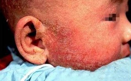 牛皮皮癬,兒童牛皮皮癬,治療牛皮癬醫院,牛皮癬專科醫院
