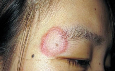 冬季銀屑病,冬季銀屑病怎樣護理,治療牛皮癬醫院,牛皮癬專科醫院