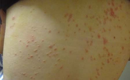 銀屑癬,銀屑癬怎樣治,治療牛皮癬醫院,牛皮癬專科醫院